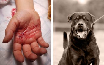 Jason, 7, attackerades av grannhundar – en av många barn som utsatts för hundattacker